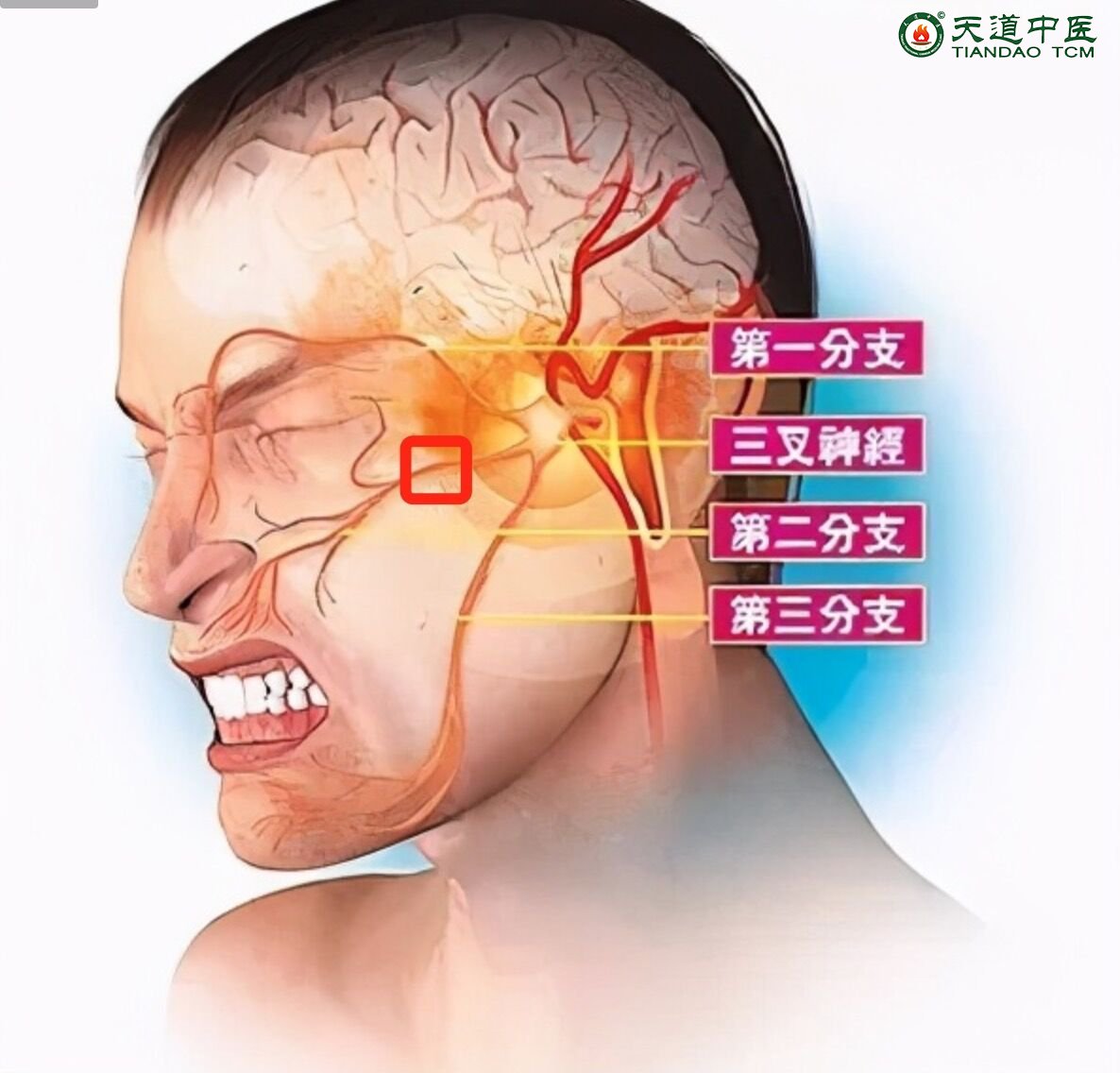 三叉神经痛