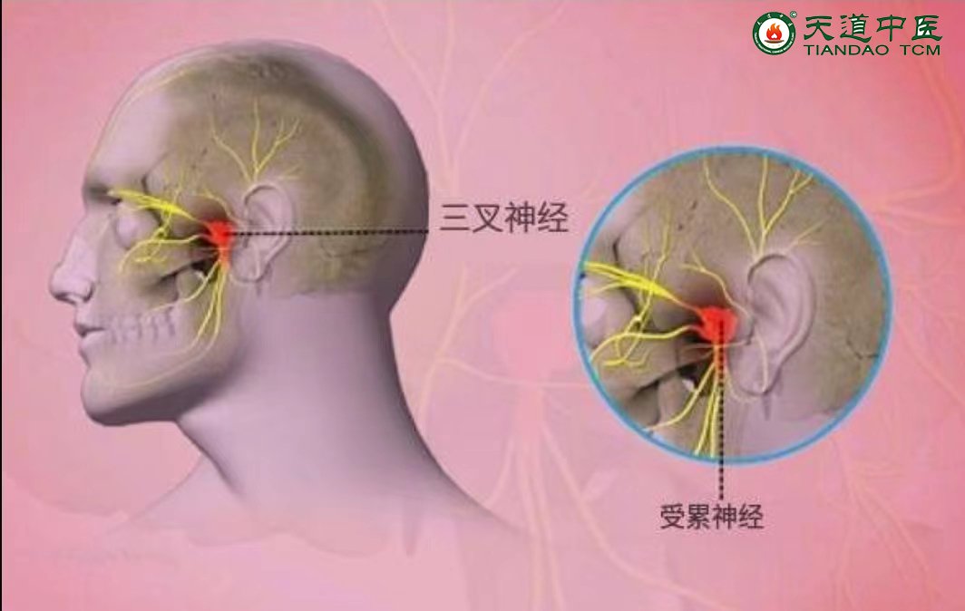 三叉神经痛