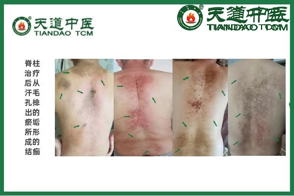 强直性脊柱炎