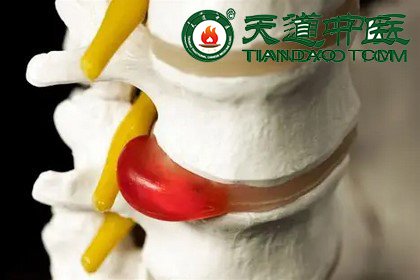 腰椎间盘突出