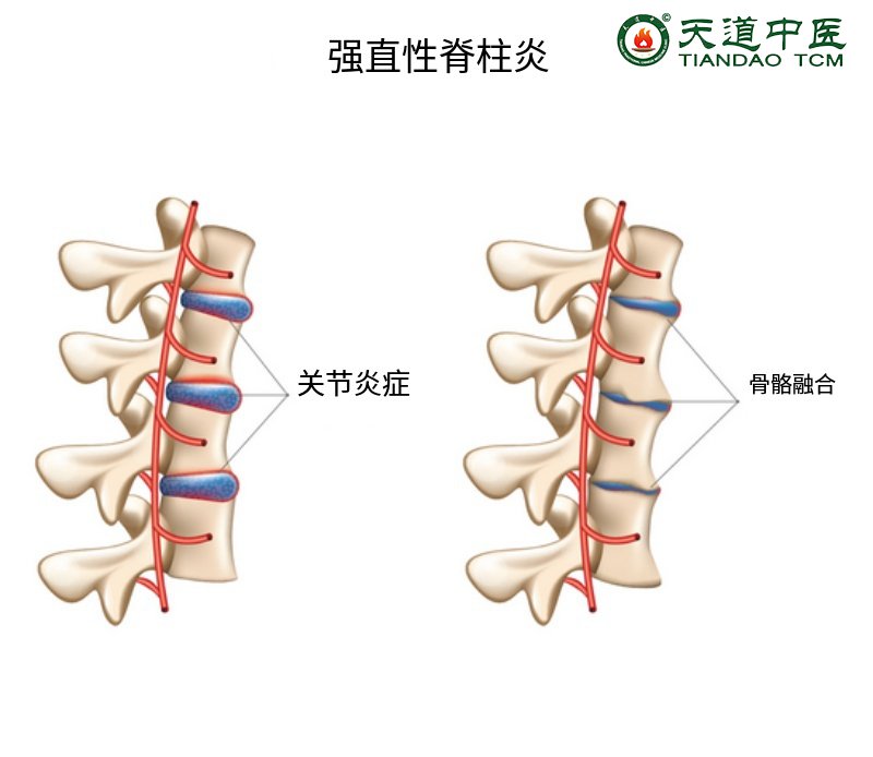 强直性脊柱炎