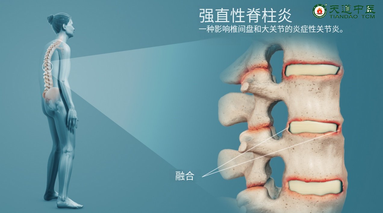 强直性脊柱炎