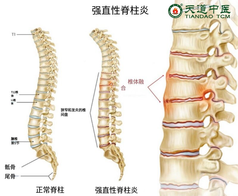 强直性脊柱炎