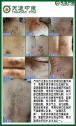 汽熥疗法：中医外治领域的创新探索，简、便、验、效，